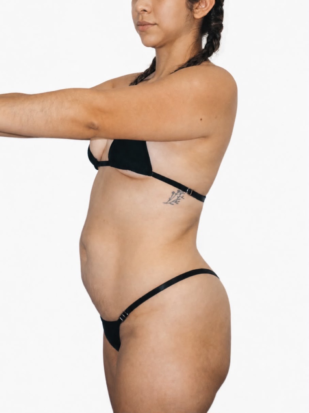 Resultado real — lipoescultura