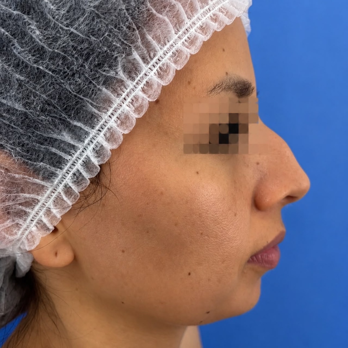 Qué preguntar antes de una rinoplastia: la guía que uso con mis pacientes