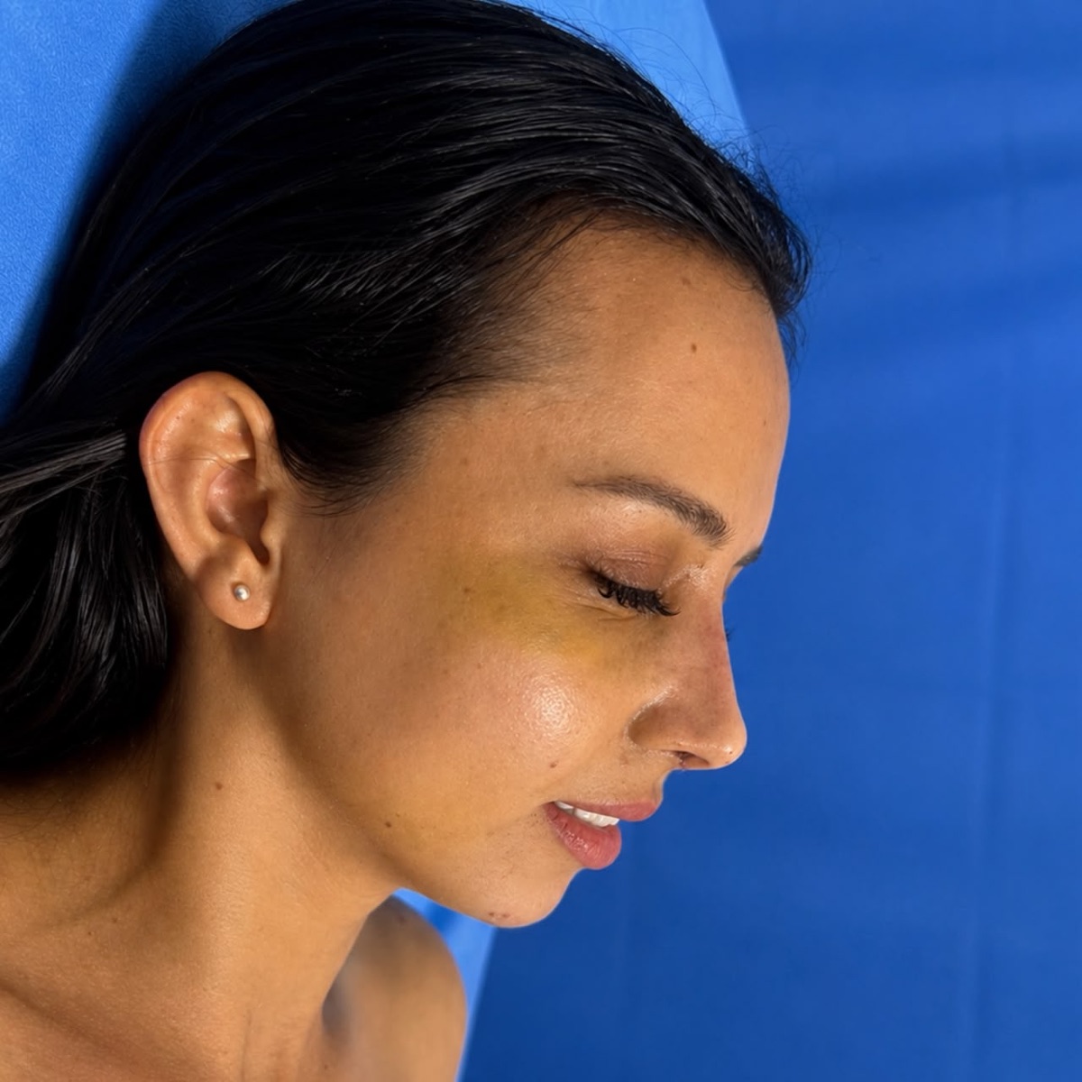 Rinoplastia